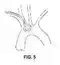 Fig. 09 - Intravascular blood filters and methods of use