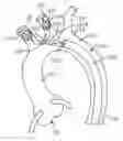 Fig. 01 - Embolic protection device