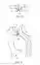 Fig. 06 - Embolic protection device