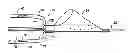Fig. 01 - Rolled tip recovery catheter