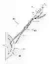 Fig. 01 - TISSUE PROTECTOR SUTURE CONSTRUCTS
