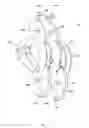 Fig. 02 - Interspinous process fusion device and method of use