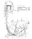 Fig. 07 - Header block for an AIMD with an abandoned lead connector cavity