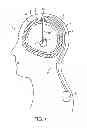 Fig. 02 - Burr hole plug having sidable clamping mechanism