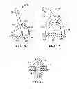 Fig. 41 - Burr hole plug having sidable clamping mechanism