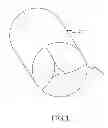 Fig. 02 - Method of controlled release of a percutaneous replacement heart valve