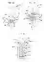Fig. 08 - Multi-layer stent