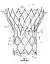 Fig. 02 - Prosthetic heart valve with expandable microspheres