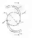 Fig. 01 - Intraocular lens