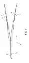 Fig. 02 - Hybrid double bundle ACL/PCL graft construct with a single graft
