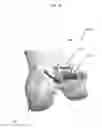 Fig. 19 - Anatomically guided instrumentation for trochlear groove replacement