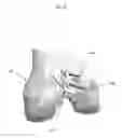 Fig. 20 - Anatomically guided instrumentation for trochlear groove replacement