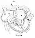 Fig. 04 - Apparatus and method for delivering a structure to a desired target site