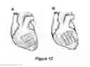 Fig. 22 - STACKED PLANAR SHEET TISSUE ENGINEERING SCAFFOLDS WITH 3D STRUCTURAL ORDER