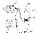 Fig. 01 - Prosthesis assembly with adjustable diameter socket