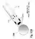 Fig. 33 - Ballooned ventilation tube cleaning device