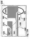 Fig. 47 - Ballooned ventilation tube cleaning device