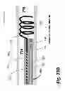 Fig. 52 - Ballooned ventilation tube cleaning device