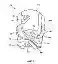 Fig. 02 - Methods of attaching cutting elements to casing bits and related structures