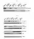 Fig. 06 - Discovery of a somatic mutation in MYD88 gene in lymphoplasmacytic lymphoma