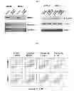 Fig. 07 - Discovery of a somatic mutation in MYD88 gene in lymphoplasmacytic lymphoma