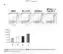 Fig. 08 - Discovery of a somatic mutation in MYD88 gene in lymphoplasmacytic lymphoma