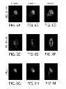 Fig. 07 - Method for enhancing folding and transport of misfolded glucocerebrosidase
