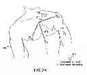 Fig. 28 - Body-worn system for continuous, noninvasive measurement of cardiac output, stroke volume, cardiac power, and blood pressure