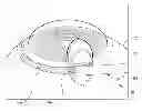 Fig. 01 - Ocular implant system and method