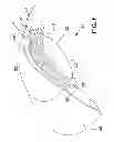 Fig. 07 - Ocular implant system and method