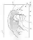 Fig. 12 - Ocular implant system and method
