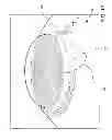 Fig. 18 - Ocular implant system and method