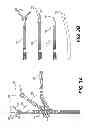 Fig. 04 - Medical devices having releasable coupling
