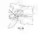 Fig. 09 - Pain management using cryogenic remodeling