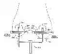 Fig. 01 - Bony balancing apparatus and method for total knee replacement