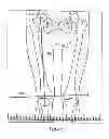 Fig. 02 - Bony balancing apparatus and method for total knee replacement