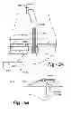 Fig. 06 - Bony balancing apparatus and method for total knee replacement