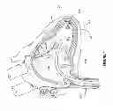 Fig. 02 - Delivery system assemblies and associated methods for implantable medical devices