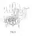 Fig. 02 - SYSTEMS AND METHODS FOR TREATMENT OF COMPRESSED NERVES