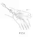 Fig. 05 - SYSTEMS AND METHODS FOR TREATMENT OF COMPRESSED NERVES
