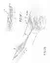 Fig. 24 - SYSTEMS AND METHODS FOR TREATMENT OF COMPRESSED NERVES