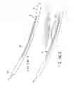 Fig. 86 - SYSTEMS AND METHODS FOR TREATMENT OF COMPRESSED NERVES