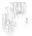 Fig. 91 - SYSTEMS AND METHODS FOR TREATMENT OF COMPRESSED NERVES