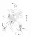 Fig. 93 - SYSTEMS AND METHODS FOR TREATMENT OF COMPRESSED NERVES
