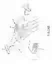 Fig. 94 - SYSTEMS AND METHODS FOR TREATMENT OF COMPRESSED NERVES