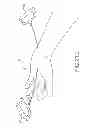 Fig. 95 - SYSTEMS AND METHODS FOR TREATMENT OF COMPRESSED NERVES