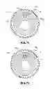 Fig. 07 - BALOON CATHETER INFLATION