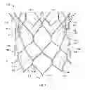 Fig. 02 - Methods of repositioning a transcatheter heart valve after full deployment
