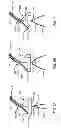 Fig. 07 - Methods of repositioning a transcatheter heart valve after full deployment