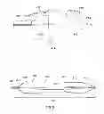 Fig. 04 - Embolic protection device